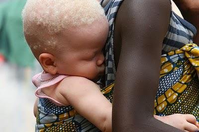 Albinism 05