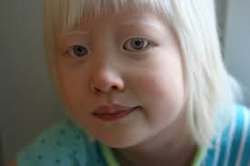 Albinism asia 00