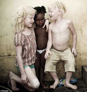 Albinism Around The World Sola Rey