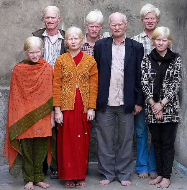 Albinism around the world